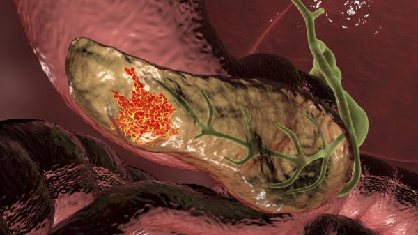 این باکتری، سرطان مرگبار لوزالمعده را درمان می نماید؟
